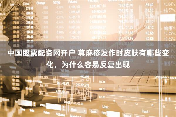 中国股票配资网开户 荨麻疹发作时皮肤有哪些变化，为什么容易反复出现